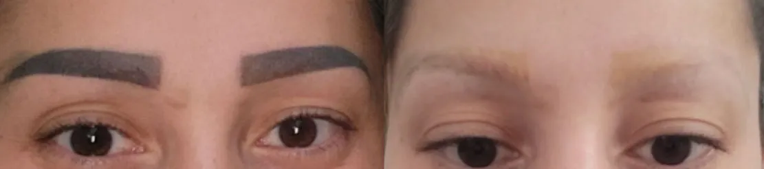 Microblading Entfernung Ergebnis nach 4 Behandlungen – Vorher Nachher