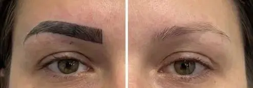 Microblading Entfernung Vorher Nachher Ergebnis